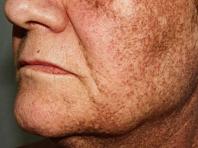 Kako se kod kuće riješiti pigmentacije na licu i tijelu