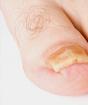 Основните заболявания на ноктите на ръцете и методи за тяхното лечение