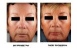 Как се прави лазерно ресърфинг на лицето Лазерно третиране на кожата на лицето
