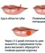 Milyen veszélyt jelent a herpesz az ajkakon terhesség alatt és hogyan lehet biztonságosan gyógyítani a betegséget Hogyan lehet gyógyítani a herpeszet a terhes nő ajkán